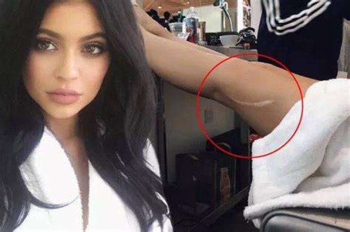 Kylie Jenner Scar on Her Leg: The Untold Story Behind the Mark